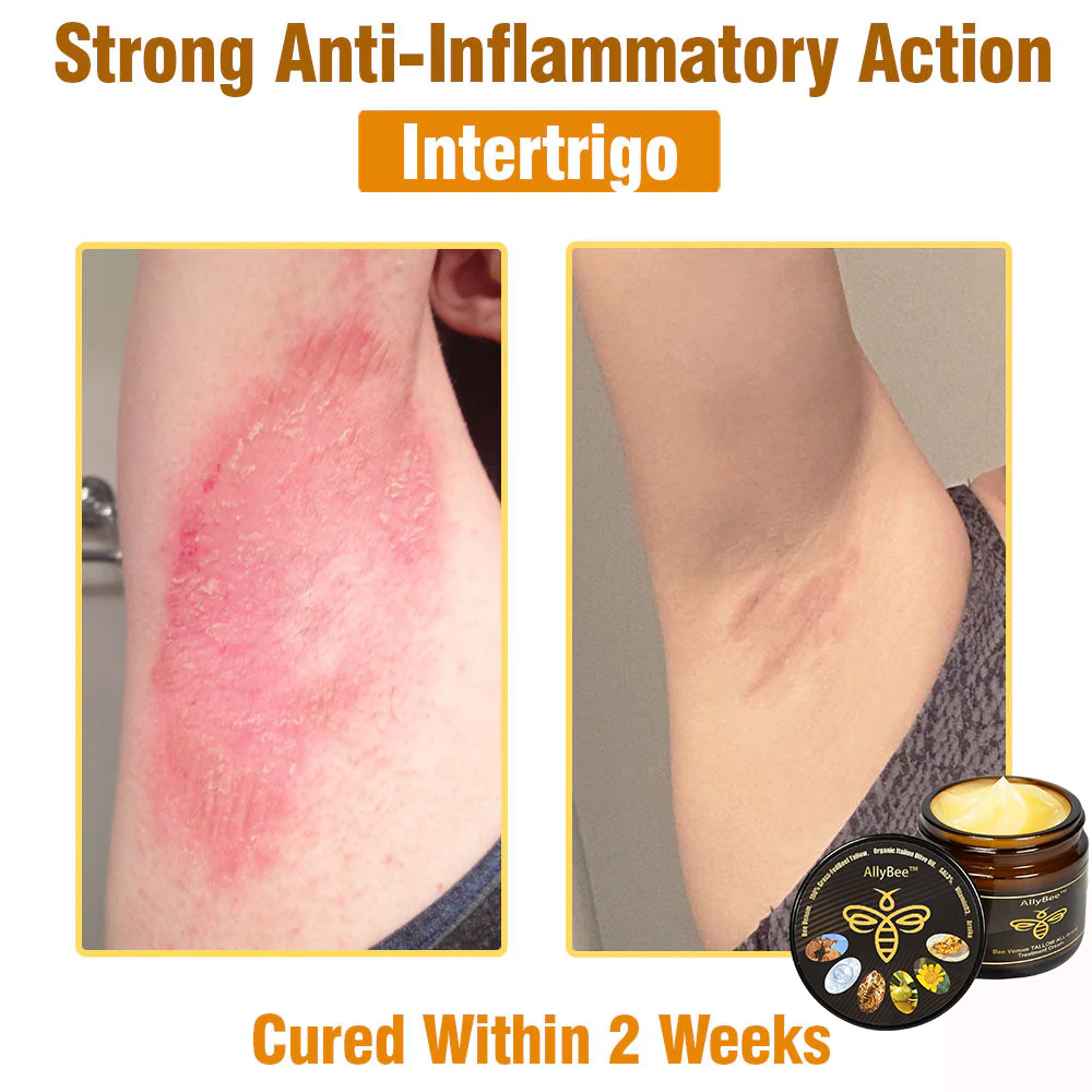 Winter Sale AllyBee™ Bee Venom TALLOW ALL-in-oneTreatment Cream 13 AllyBee™ Bee Venom TALLOW ALL-in-oneTreatment Cream for Anti-Aging, Acne, Scars, Warts, Psoriasis, Dark Spots, Wrinkles & Eczema Relief
