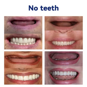 Top Deal Bikenda™ Silicone Denture Ruler Set (CED Compliant Approved By Professional Dentists) 18 Bikenda™ Silicone Denture Ruler Set (CED Compliant Approved By Professional Dentists)