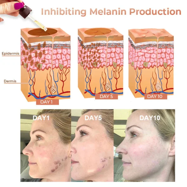 Winter Sale Fast Dark Spot Remover-Dobshow™ Melanin Correcting Facial Serum - Image 5