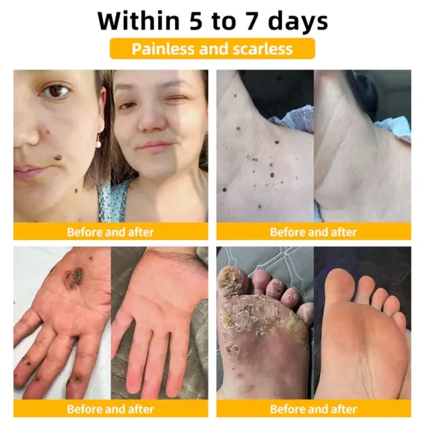 Huge Offer Turonu™ Bee Venom Mole and Wart Treatment Cream. - Image 5