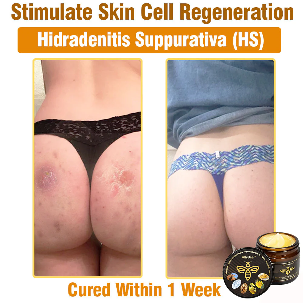 Winter Sale AllyBee™ Bee Venom TALLOW ALL-in-oneTreatment Cream 11 AllyBee™ Bee Venom TALLOW ALL-in-oneTreatment Cream for Anti-Aging, Acne, Scars, Warts, Psoriasis, Dark Spots, Wrinkles & Eczema Relief