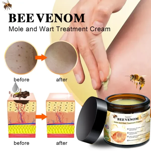 Huge Offer Turonu™ Bee Venom Mole and Wart Treatment Cream. - Image 2
