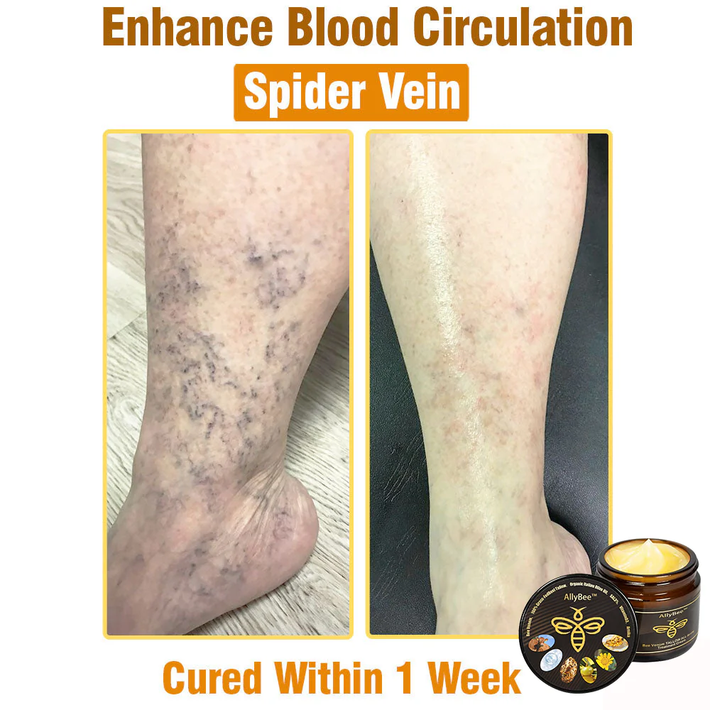 Winter Sale AllyBee™ Bee Venom TALLOW ALL-in-oneTreatment Cream 10 Winter Sale AllyBee™ Bee Venom TALLOW ALL-in-oneTreatment Cream - Image 10