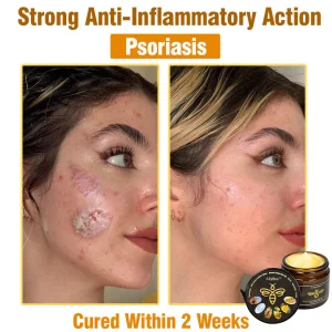 Winter Sale AllyBee™ Bee Venom TALLOW ALL-in-oneTreatment Cream 18 AllyBee™ Bee Venom TALLOW ALL-in-oneTreatment Cream for Anti-Aging, Acne, Scars, Warts, Psoriasis, Dark Spots, Wrinkles & Eczema Relief