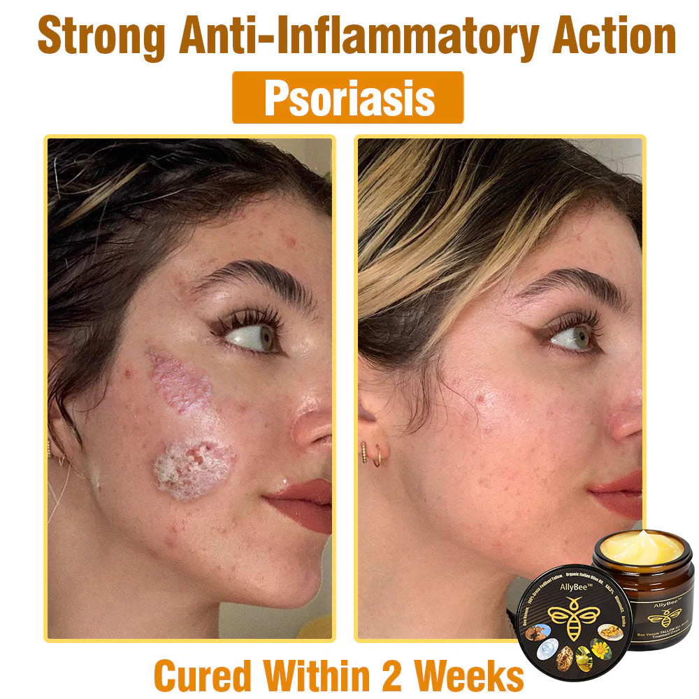 Winter Sale AllyBee™ Bee Venom TALLOW ALL-in-oneTreatment Cream 5 AllyBee™ Bee Venom TALLOW ALL-in-oneTreatment Cream for Anti-Aging, Acne, Scars, Warts, Psoriasis, Dark Spots, Wrinkles & Eczema Relief