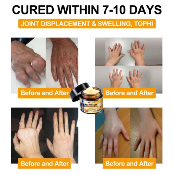 Aetheris™ Bee-Venom Pain- Relief Bone Healing Cream