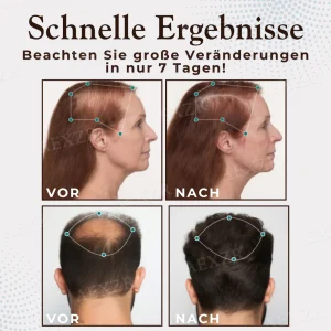 Hairgenz™ Haarwachstum Kapseln - BEGRENZTES ANGEBOT | Jetzt kein Haarausfall mehr!💕