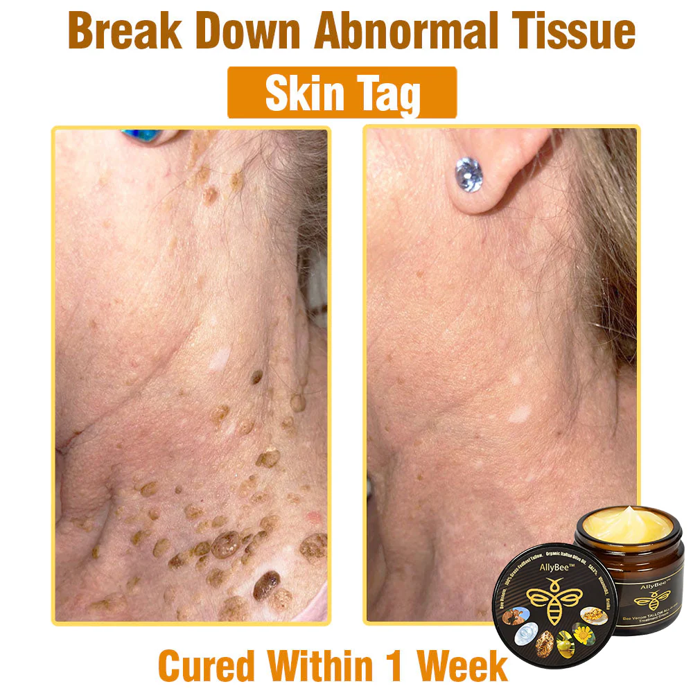 Winter Sale AllyBee™ Bee Venom TALLOW ALL-in-oneTreatment Cream 7 AllyBee™ Bee Venom TALLOW ALL-in-oneTreatment Cream for Anti-Aging, Acne, Scars, Warts, Psoriasis, Dark Spots, Wrinkles & Eczema Relief