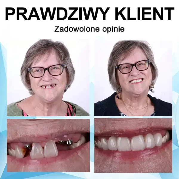 Furzero™Adjustable dentures – the best alternative to expensive braces