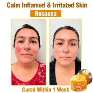 Daasry® Bee Venom Skin Treatment Serum Cream