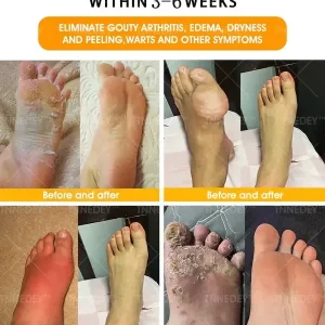 Jorondy® Bee Venom🐝 and 30 Herbs Detox Foot Bath Beads for Detoxification – Recommended by the South African Society of Physiotherapy
