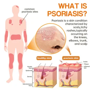 LOVILDS™PsoriaHeal psoriasis and Eczema Spray pro -Buy 1 Get 1 FREE
