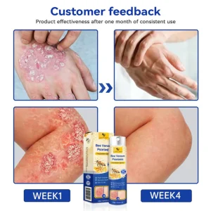 LOVILDS™PsoriaHeal psoriasis and Eczema Spray pro -Buy 1 Get 1 FREE