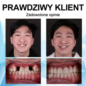 Furzero™Adjustable dentures – the best alternative to expensive braces