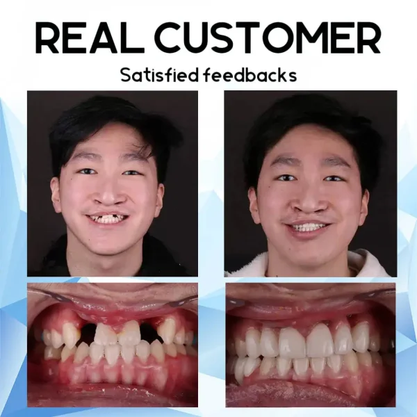 🦷 QIAWI™-Premium Custom Silicone Denture Set 👨‍⚕️ American Dental Association (ADA) certified
