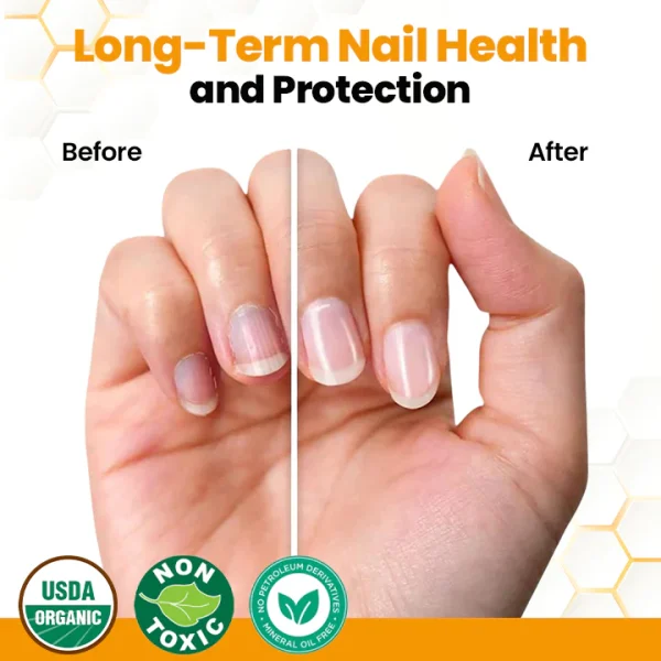 Biancat™ BeeVenom Anti-Fungal Nail Renewal Oil -👨‍⚕️ American Academy of Dermatology (AAD) Approved