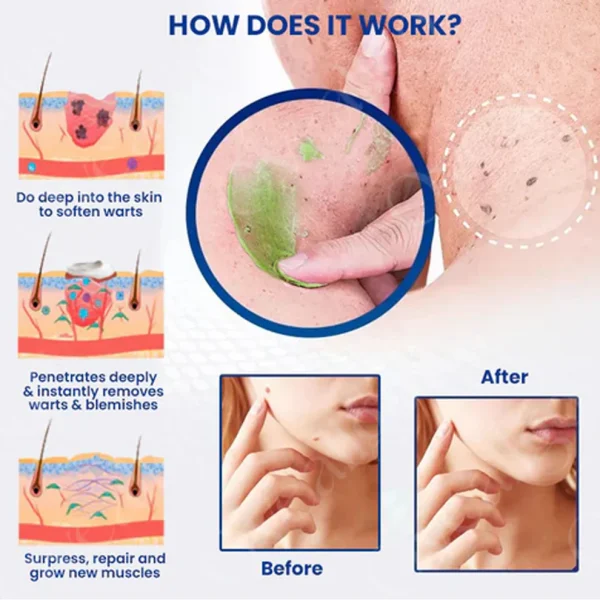Oveallgo™ NatureErase Instant Mole & Spot Removal Gel