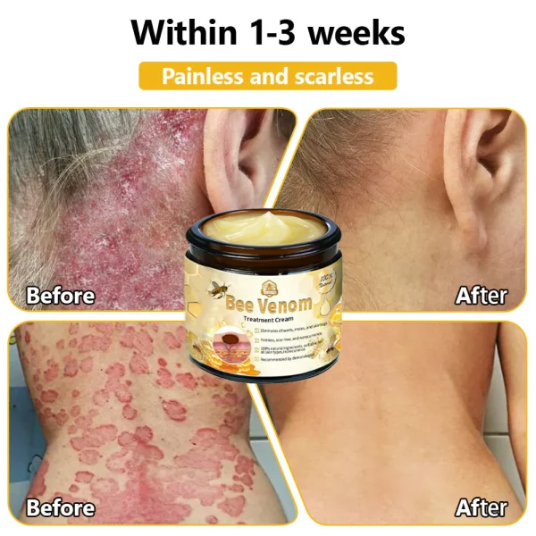 Turonu™ Bee Venom Treatment Cream