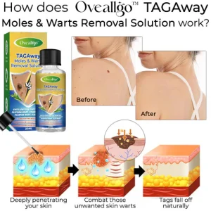 Oveallgo™ TAGAway Moles & Warts Removal Solution 10 Oveallgo™ TAGAway Moles & Warts Removal Solution