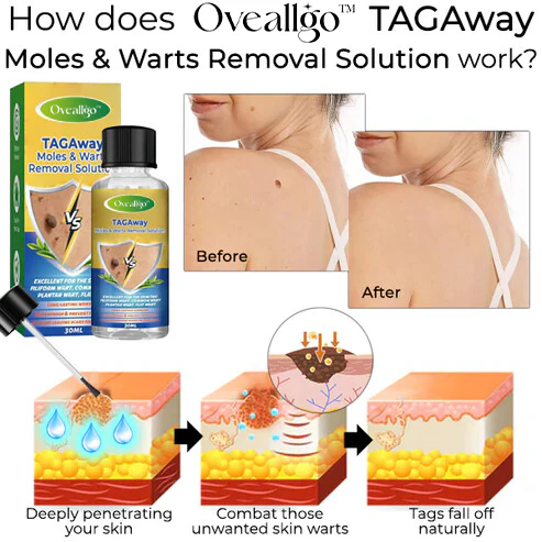 Oveallgo™ TAGAway Moles & Warts Removal Solution 4 Oveallgo™ TAGAway Moles & Warts Removal Solution