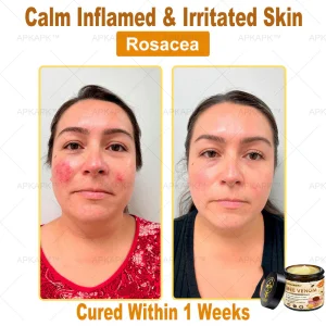 APKAPK™ Bee Venom Skin Treatment Cream, Anti-aging, Hydrating, Skin Repair, Even Tone, Acne and Dark Spot Treatment, Wart and Mole Removal, Psoriasis Relief
