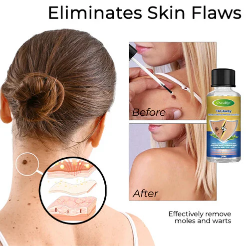 Oveallgo™ TAGAway Moles & Warts Removal Solution 3 Oveallgo™ TAGAway Moles & Warts Removal Solution