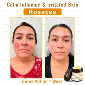 TGA Approved: Daasry® Botox Bee Venom Skin Treatment Cream