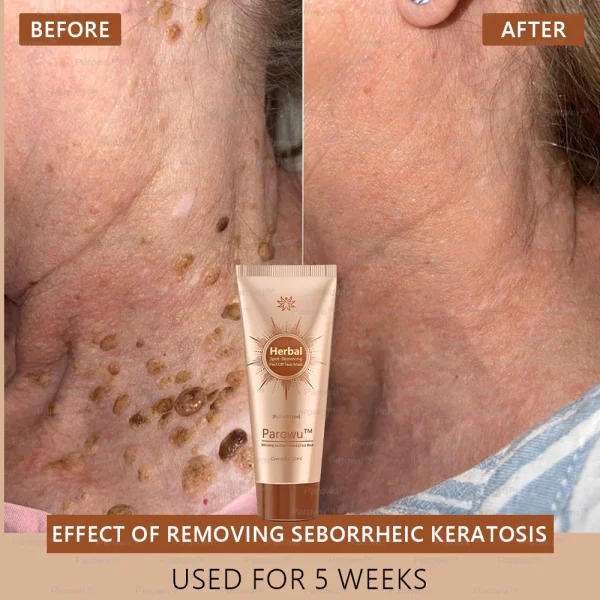 v🧡Parowu™ Whitening and Spot-Removing Face Mask Suitable for face and body – 👩‍⚕️ Natural ingredients permanently remove age spots, freckles, sun spots, and liver spots