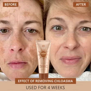 🧡Parowu™ Whitening and Spot-Removing Face Mask Suitable for face and body – 👩‍⚕️ Natural ingredients permanently remove age spots, freckles, sun spots, and liver spots