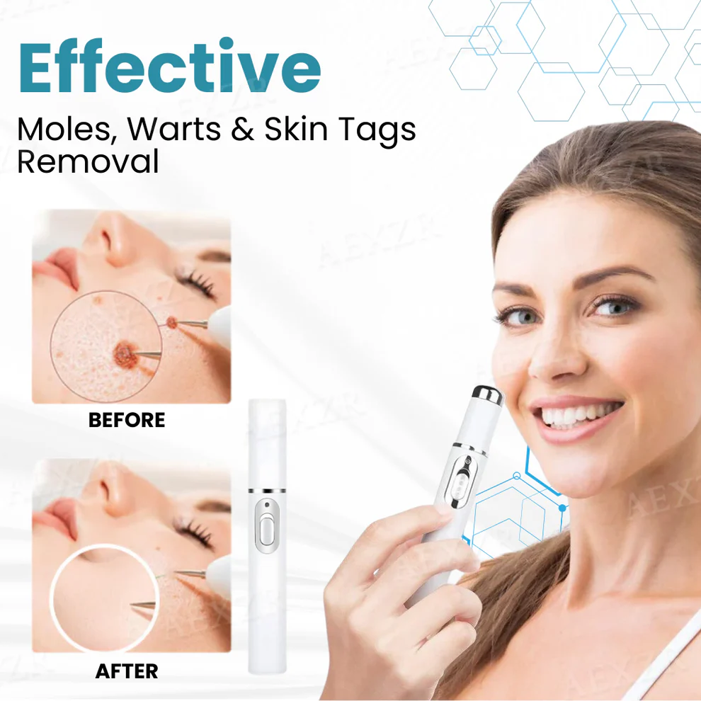 Nurbini™ Non-invasive Mole and Wart Removal Laser Pen 5 Nurbini™ Non-invasive Mole and Wart Removal Laser Pen