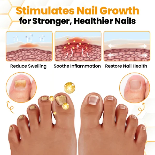 Biancat™ BeeVenom Anti-Fungal Nail Renewal Oil -👨‍⚕️ American Academy of Dermatology (AAD) Approved