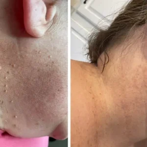 JEREMYTIS™Skin Tag Removal Kit