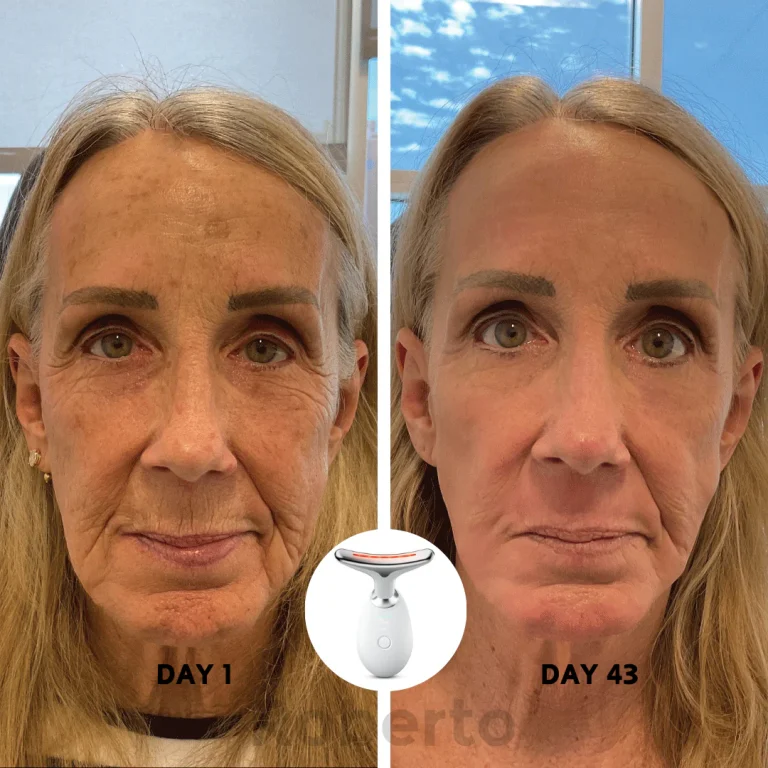 Roberto™ Anti-Aging Device 2 Roberto™ Anti-Aging Device