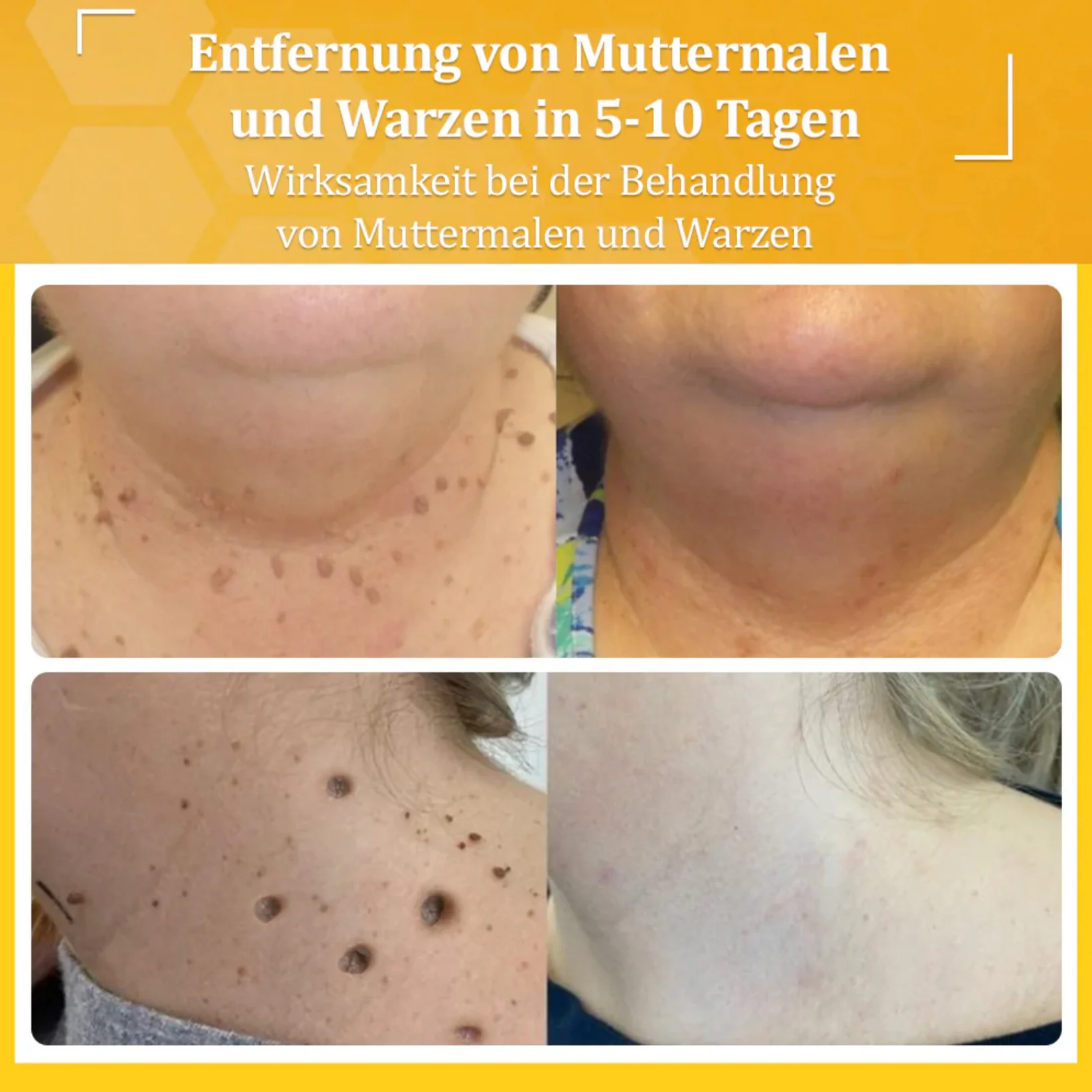 Fivfivgo™ TagCure Bee Venom Cream for Wart and Mole Removal 10 Fivfivgo™ TagCure Bee Venom Cream for Wart and Mole Removal - Image 10