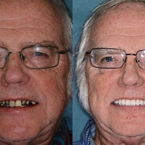 HZA™ Advanced Customized Full Denture Set 18 03