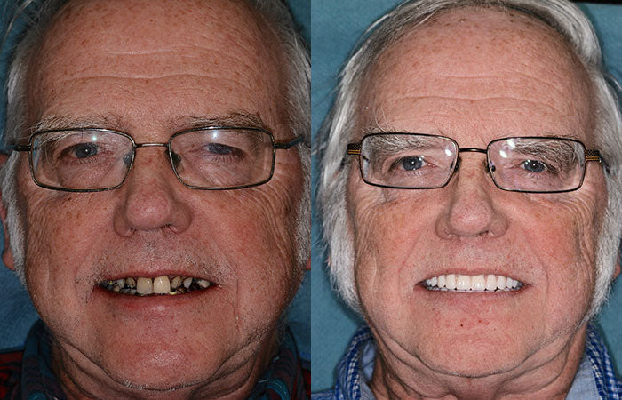 HZA™ Advanced Customized Full Denture Set 8 HZA™ Advanced Customized Full Denture Set - Image 8