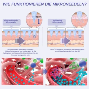 Honxi® NIDDK-Tirzepatid Nano-Mikronadel-Pflaster