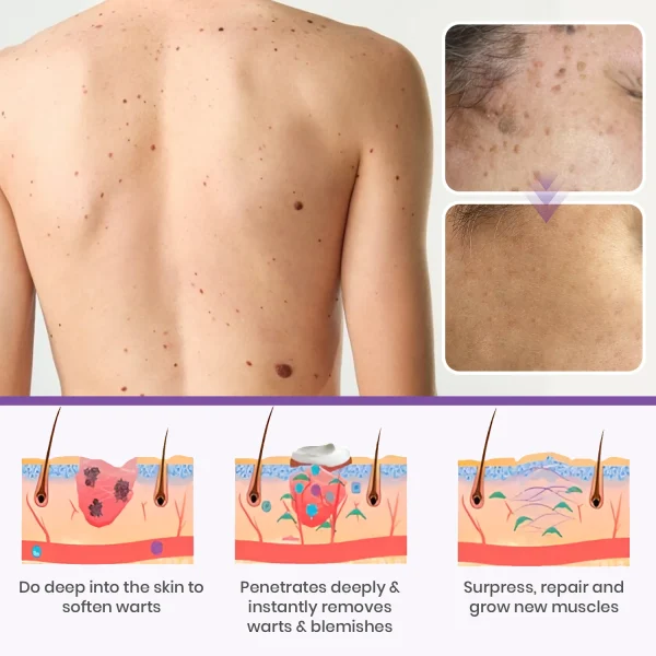 Fivfivgo® Clarivine Dissolver Mole & Dark Spot Removal Bio-Gel