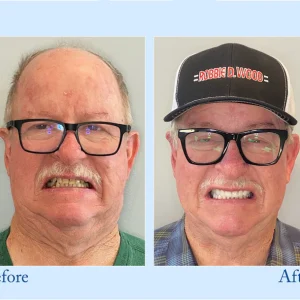 Smileasego™ - Premium Denture