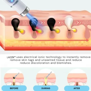 LAOZIK® Non-Invasive Mole and Wart Removal Laser Pen 14 LAOZIK® Non-Invasive Mole and Wart Removal Laser Pen