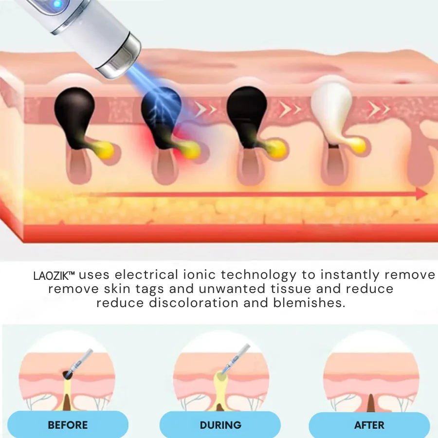 LAOZIK® Non-Invasive Mole and Wart Removal Laser Pen 7 LAOZIK® Non-Invasive Mole and Wart Removal Laser Pen