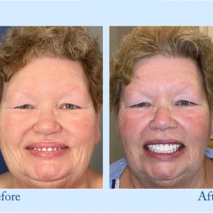 Smileasego™ - Premium Denture