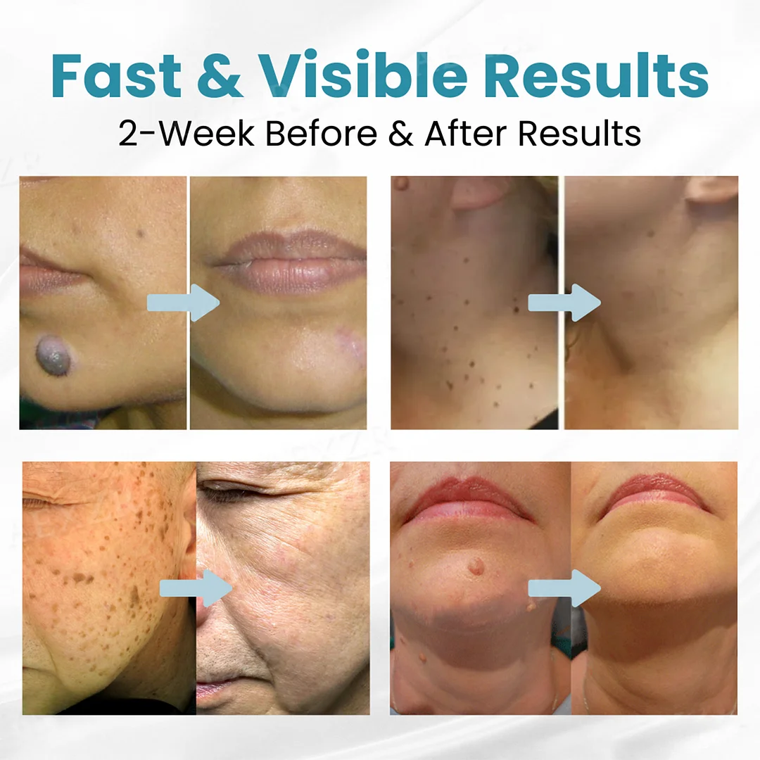 LAOZIK® Non-Invasive Mole and Wart Removal Laser Pen 2 LAOZIK® Non-Invasive Mole and Wart Removal Laser Pen