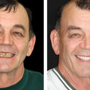 HZA™ Advanced Customized Full Denture Set 21 R ac9f3eaf 5c0f 4995 b8c0 70b6c5e6a157