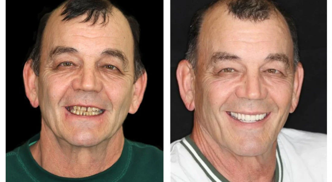 HZA™ Advanced Customized Full Denture Set 11 HZA™ Advanced Customized Full Denture Set - Image 11