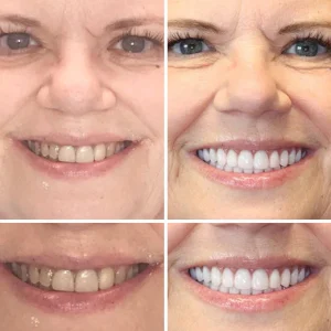 HZA™ Advanced Customized Full Denture Set 16 HZA™ --🦷Advanced Customized Full Denture Set