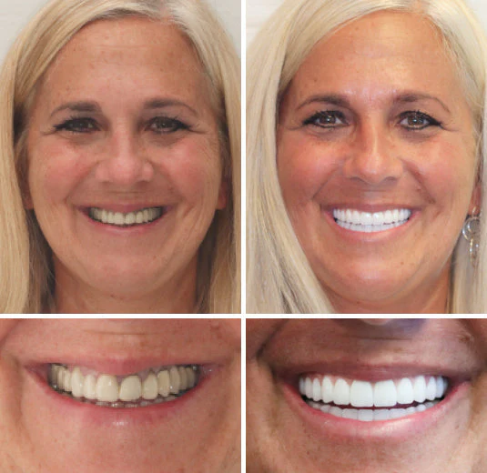 HZA™ Advanced Customized Full Denture Set 5 HZA™ --🦷Advanced Customized Full Denture Set