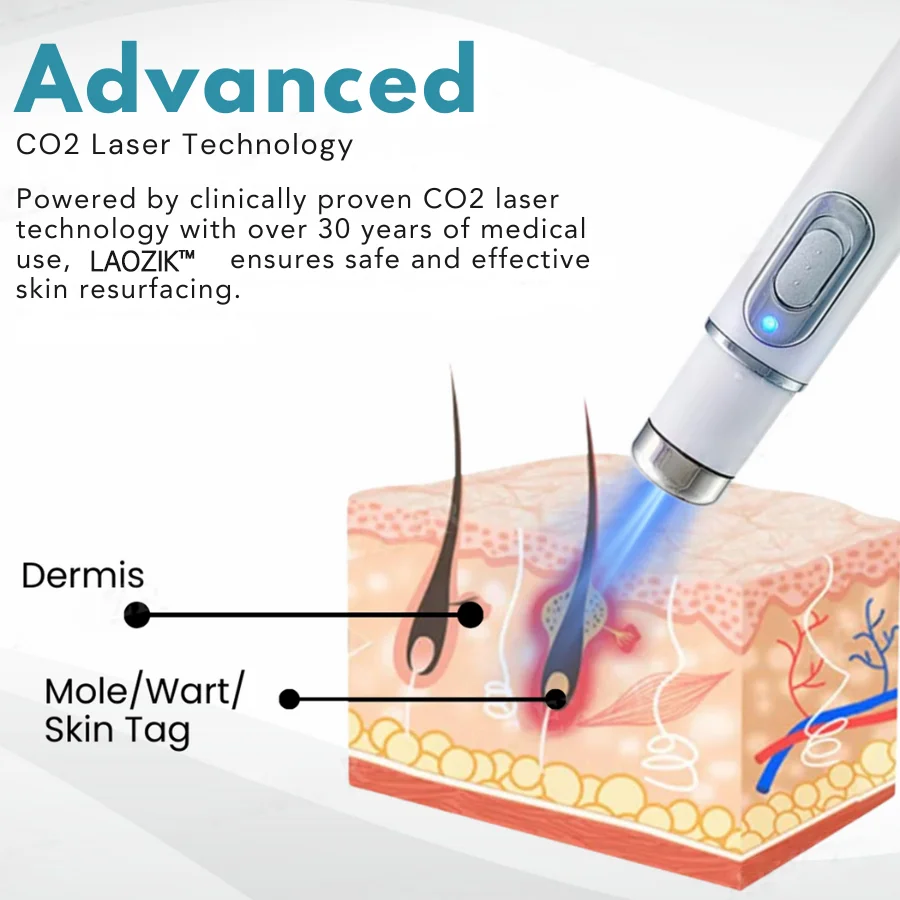 LAOZIK® Non-Invasive Mole and Wart Removal Laser Pen 5 LAOZIK® Non-Invasive Mole and Wart Removal Laser Pen