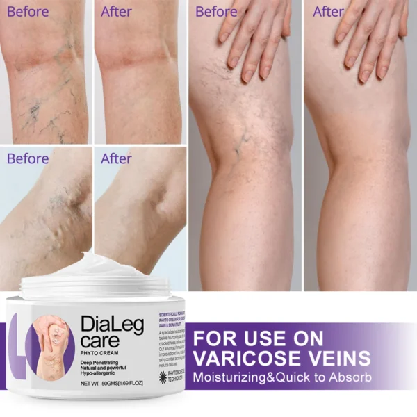 Coastglee® DiaLeg Care Phyto Cream - Helps Treat Varicose Veins